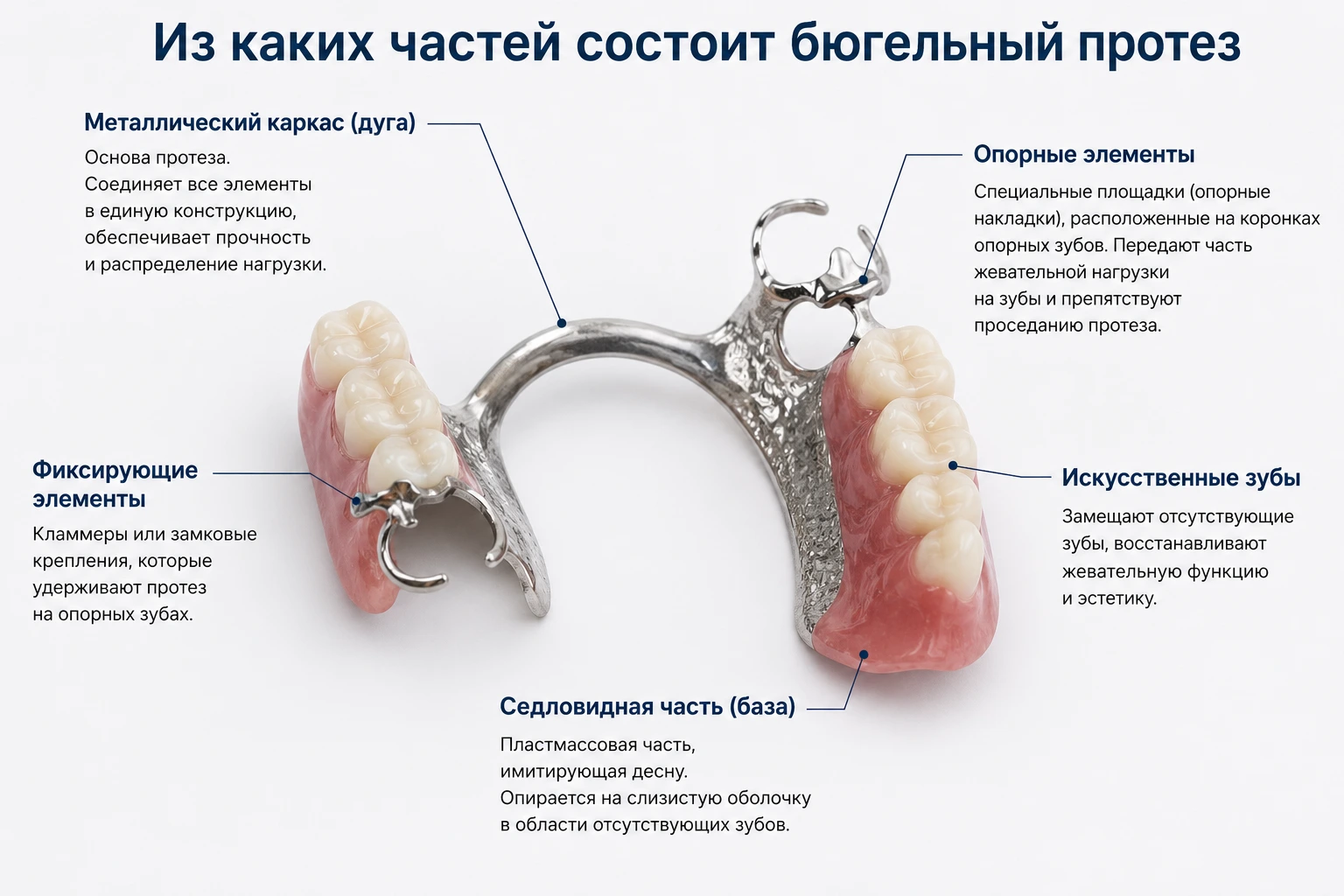 Из каких частей состоит бюгельный протез